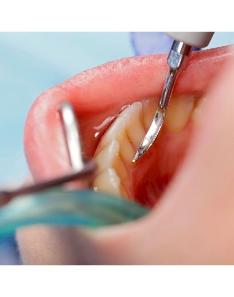 Limpieza Dental