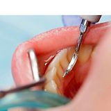 Limpieza Dental