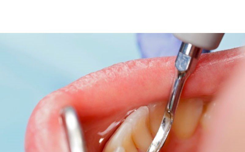 Limpieza Dental
