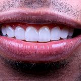 Diseño de Sonrisa