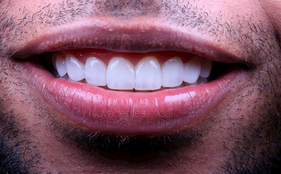 Diseño de Sonrisa