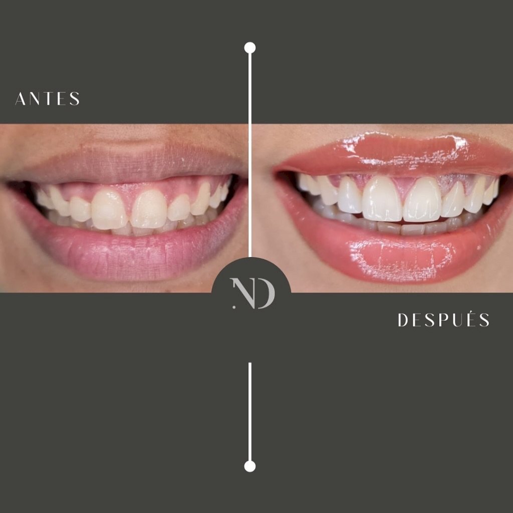 Diseño de Sonrisa