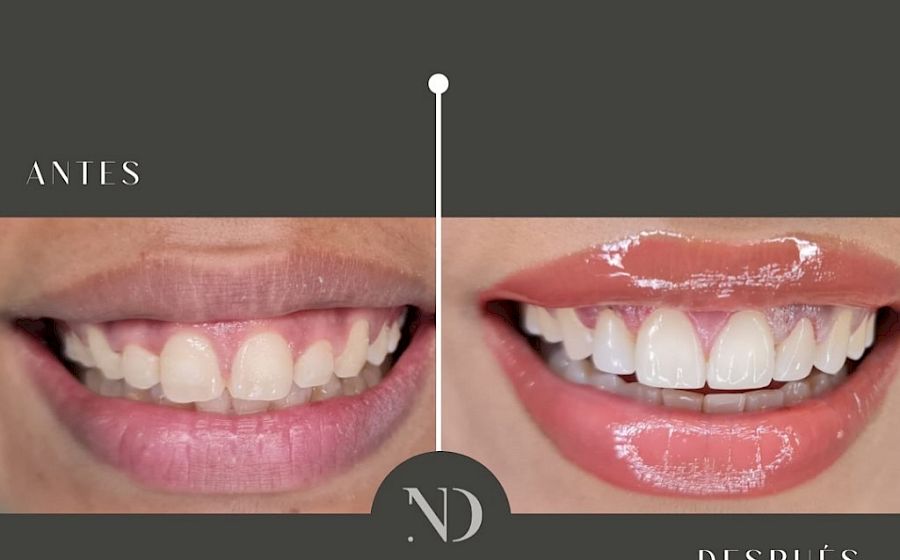 Diseño de Sonrisa