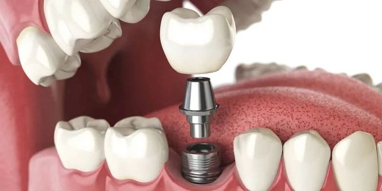 Implantes