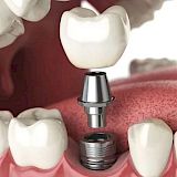 Implantes