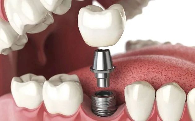 Implantes