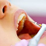 Endodoncias