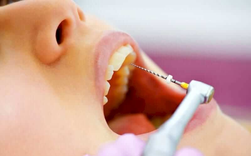 Endodoncias