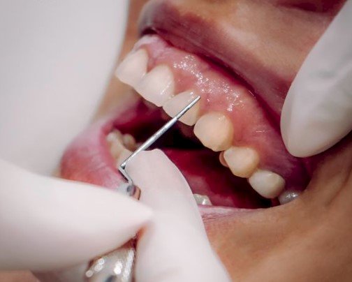 Periodoncia