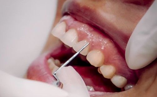Periodoncia