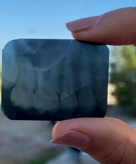 Radiografia Periapical
