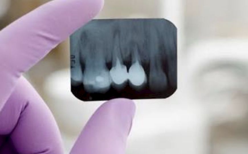 Radiografia Periapical