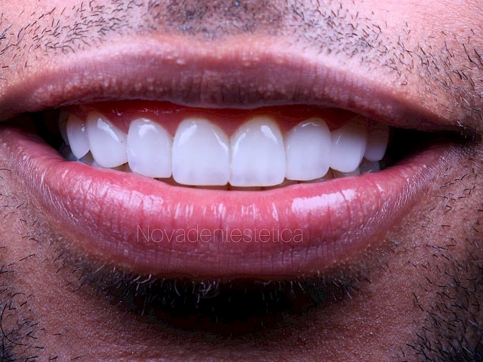 NovaDent - Odontología Clínica dental en la chorrera Nuestros trabajos